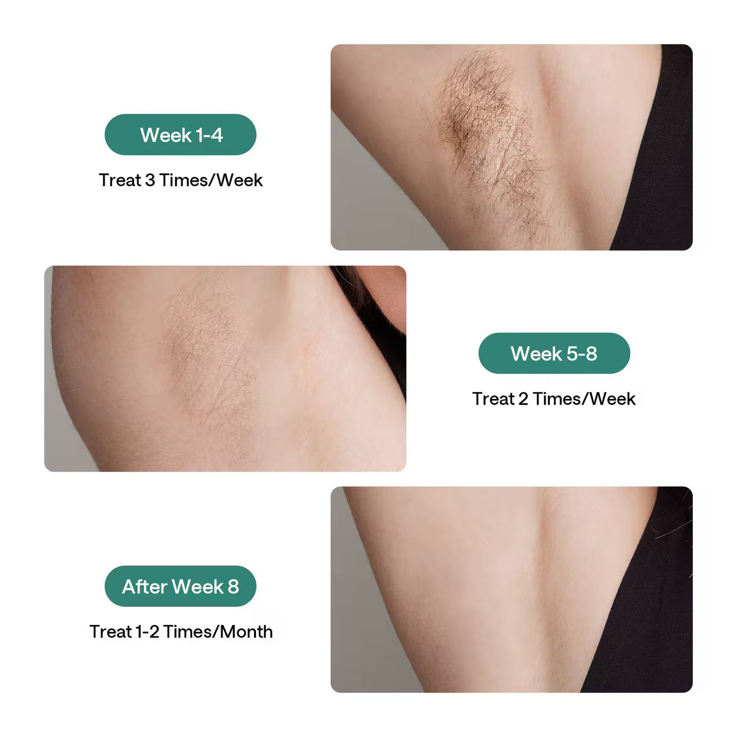 Ulike #1 Pain-Free At-Home IPL Laser Hair Removal