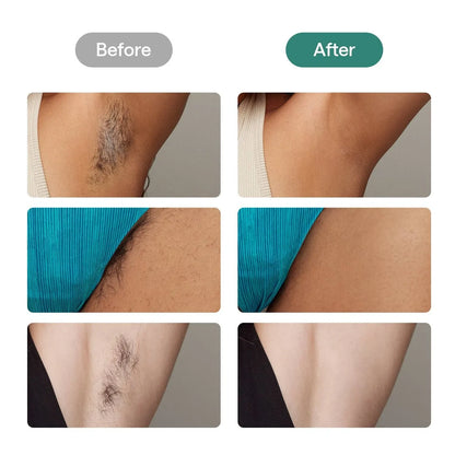 Ulike #1 Pain-Free At-Home IPL Laser Hair Removal