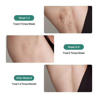 Ulike #1 Pain-Free At-Home IPL Laser Hair Removal
